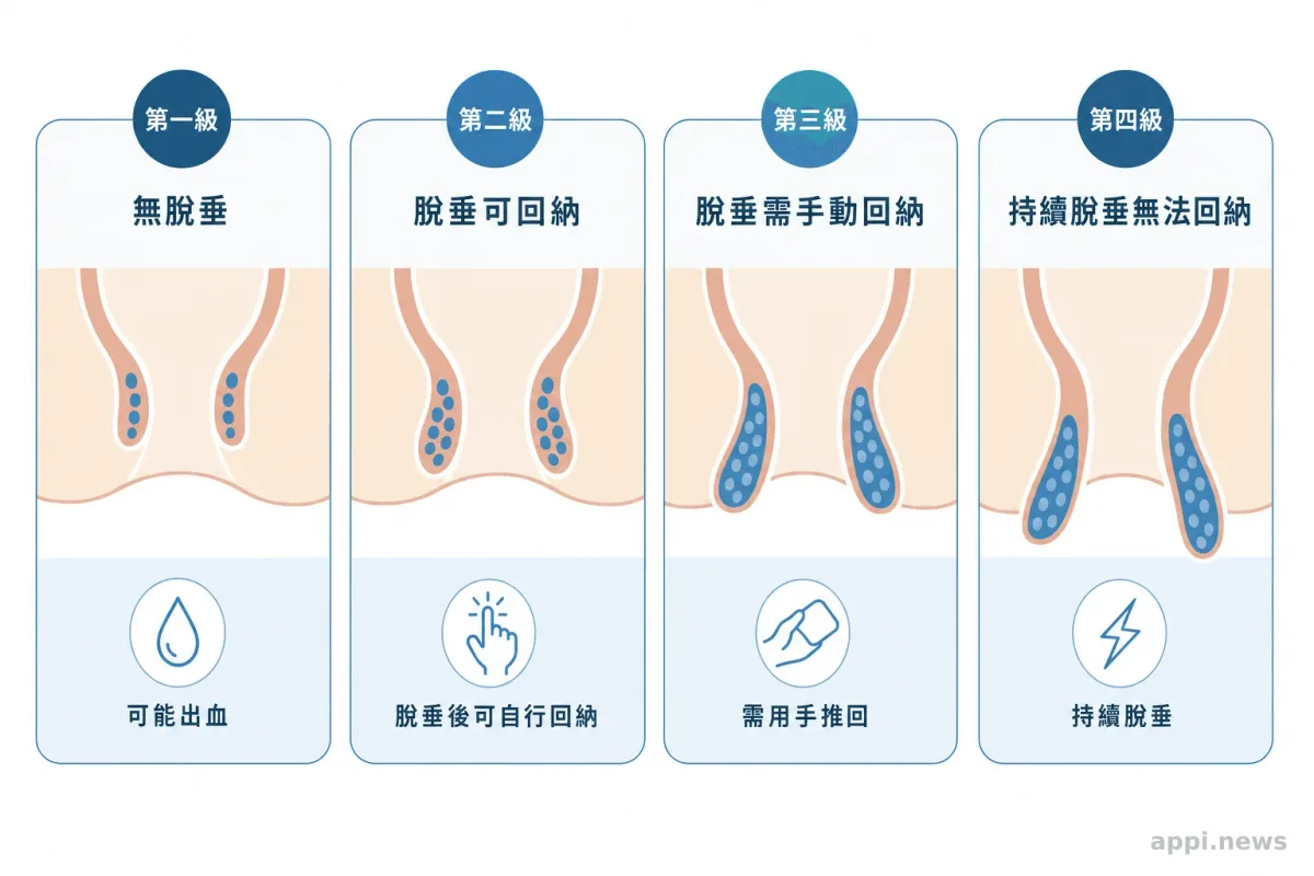 痔瘡症狀分級示意圖,從第一級到第四級的脫垂程度