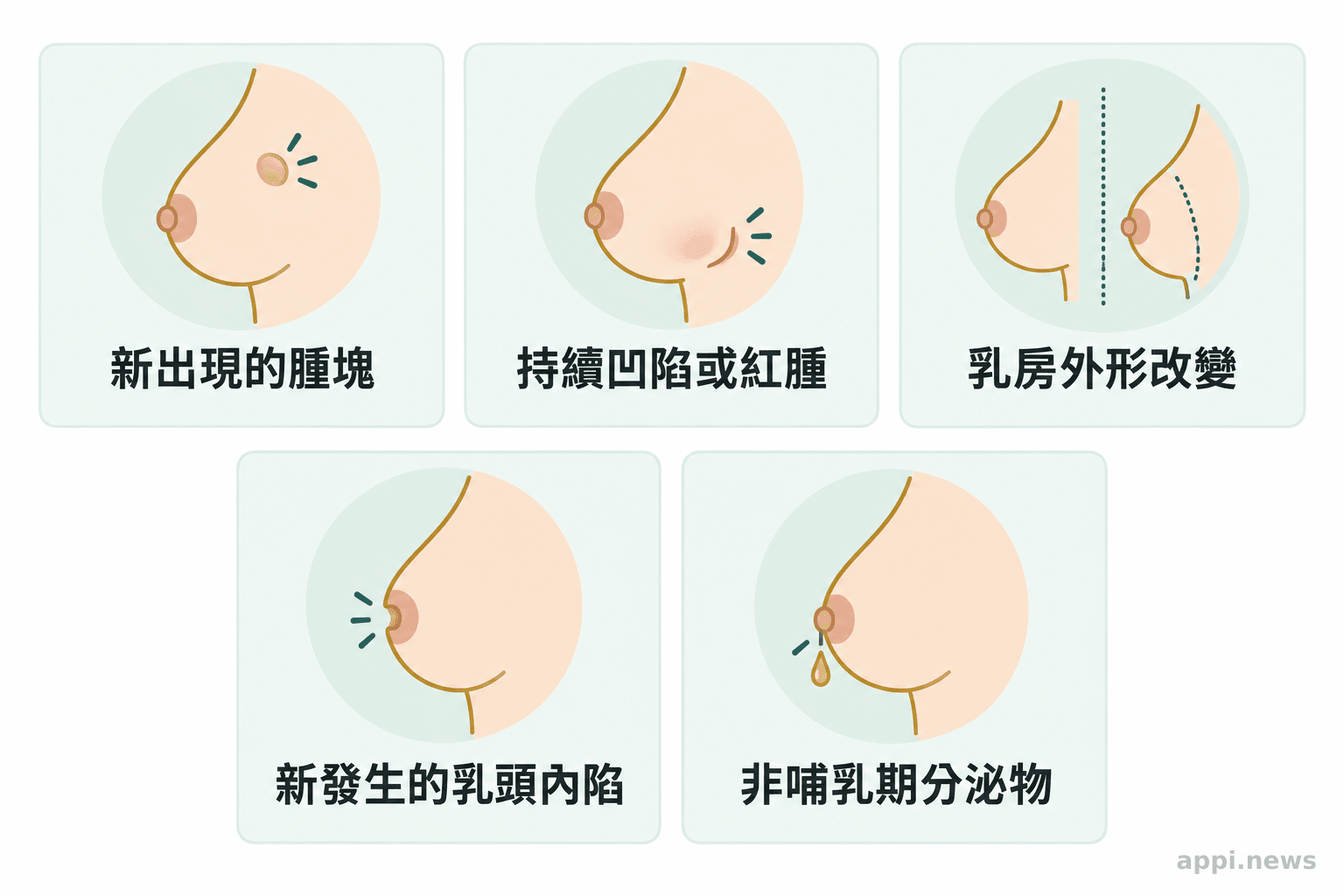 圖中以分開標示的示意圖呈現新腫塊、皮膚凹陷或紅腫、乳房外形改變、新發生的乳頭內陷，以及非哺乳期分泌物。