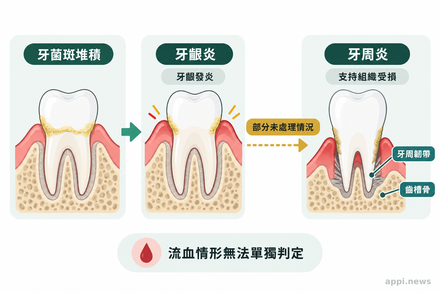 牙齒剖面圖以箭頭呈現牙菌斑刺激牙齦發炎,以及部分未處理情況可能出現的牙周支持組織與齒槽骨破壞。