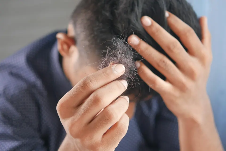 一名男性雙手捧著從頭頂脫落的一束頭髮，頭部微低