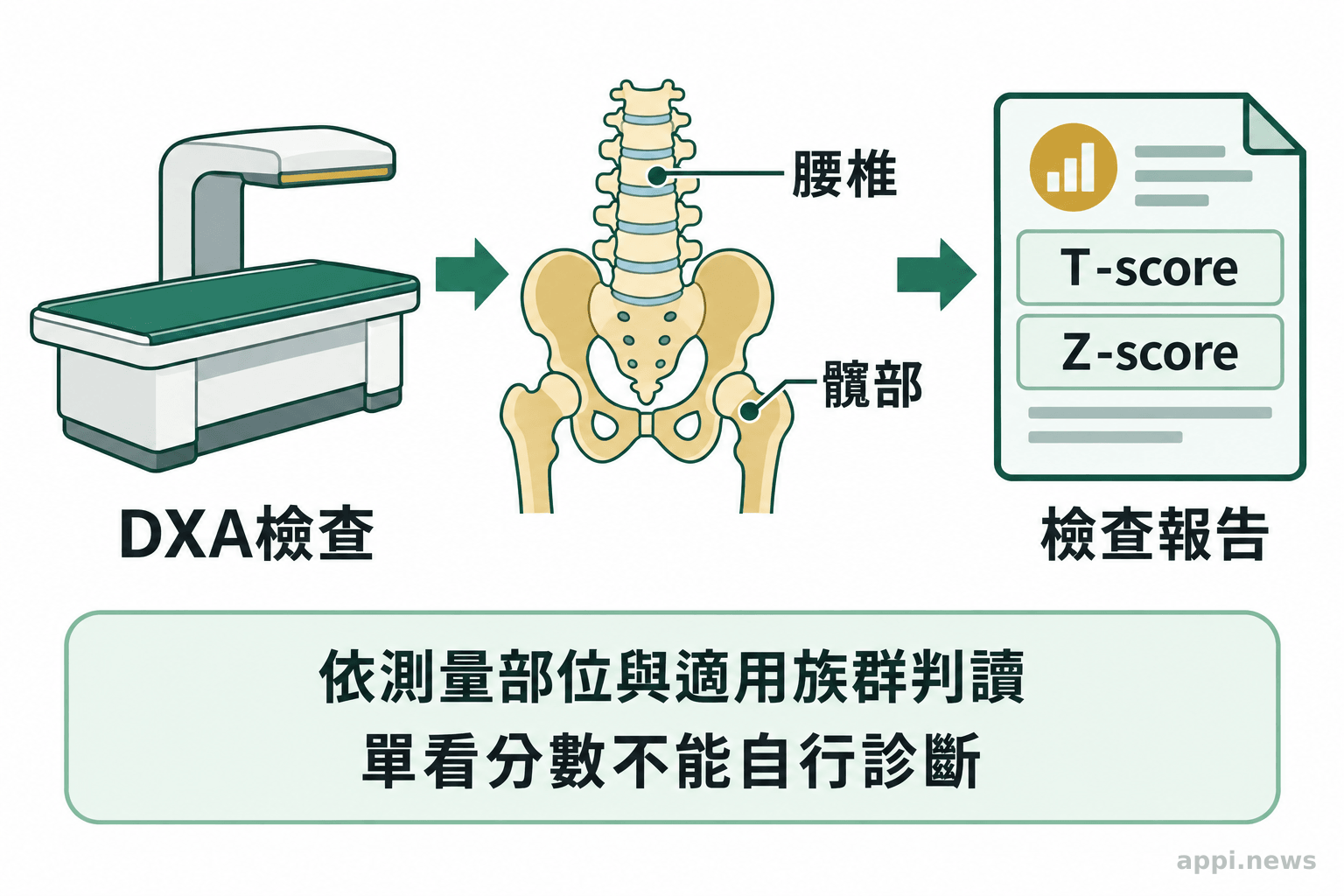 DXA檢查儀器連接腰椎與髖部測量示意,再以報告標示T-score和Z-score。