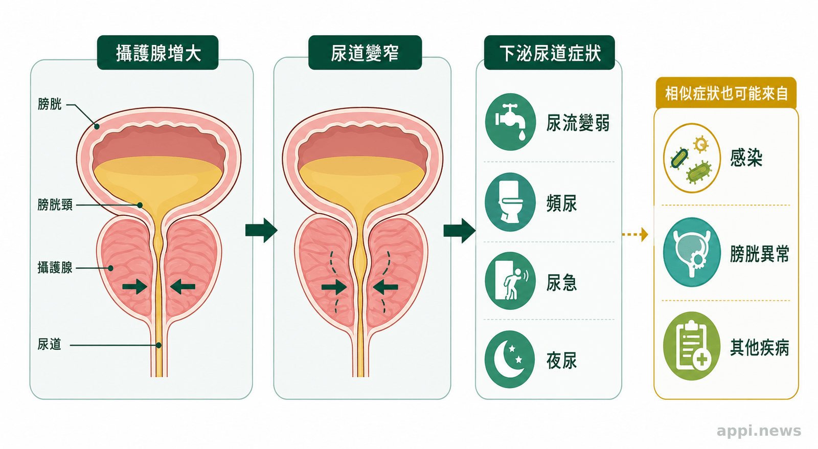 膀胱下方的攝護腺增大並壓迫尿道，旁邊標示尿流變弱、頻尿與夜尿等症狀