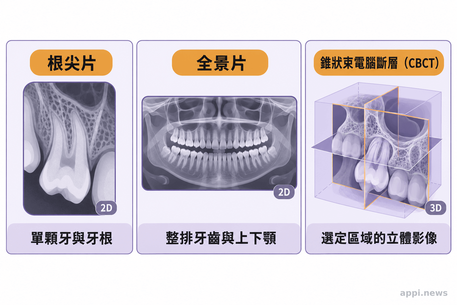 三個並排影像示意區分別呈現單顆牙根尖片、較大範圍的全景片與局部三維 CBCT。